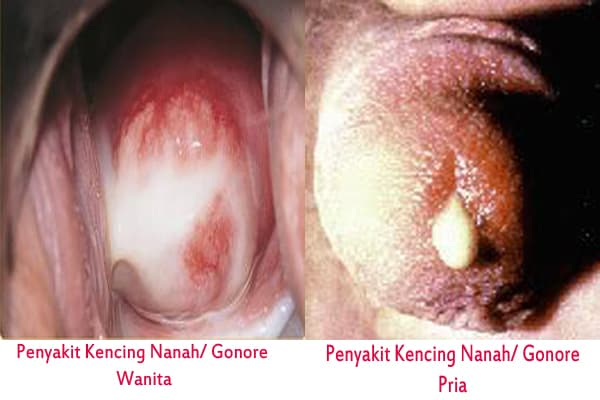 obat kencing nanah