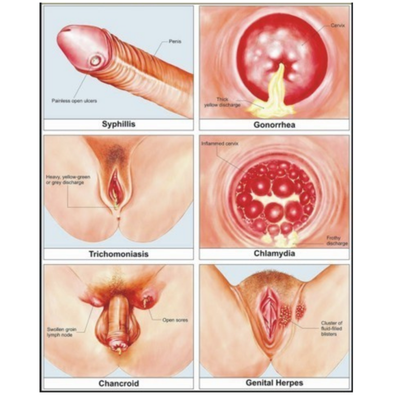 obat kencing nanah