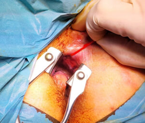 pengobatan fistula ani